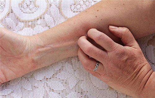 AB膠皮膚過敏解決辦法